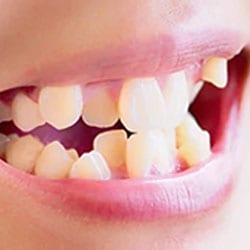 A clinical photograph from the Liphook Smile Studio image library