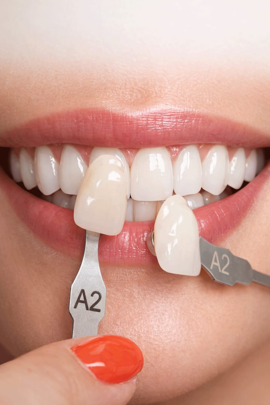 Porcelain veneers being matched to a patient’s natural teeth
